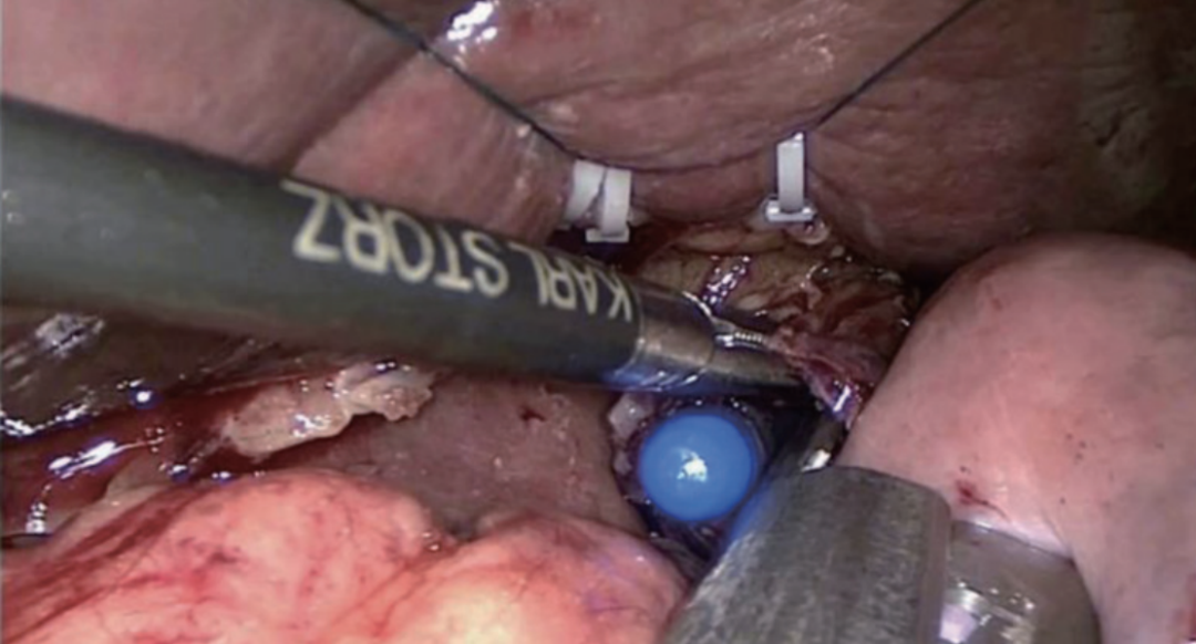 肠道吻合器是什么材质尤俊等人：术后消化道重建之Overlap、FETE、Billroth+Braun吻合｜《腹腔镜胃肠手术笔记（第二版）》新书抢先看_https://www.jmylbn.com_新闻资讯_第23张