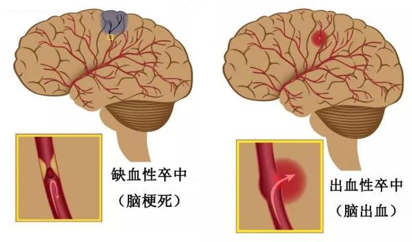 脑梗死后遗症,脑出血后遗症,脑炎后遗症,脑外伤后遗症