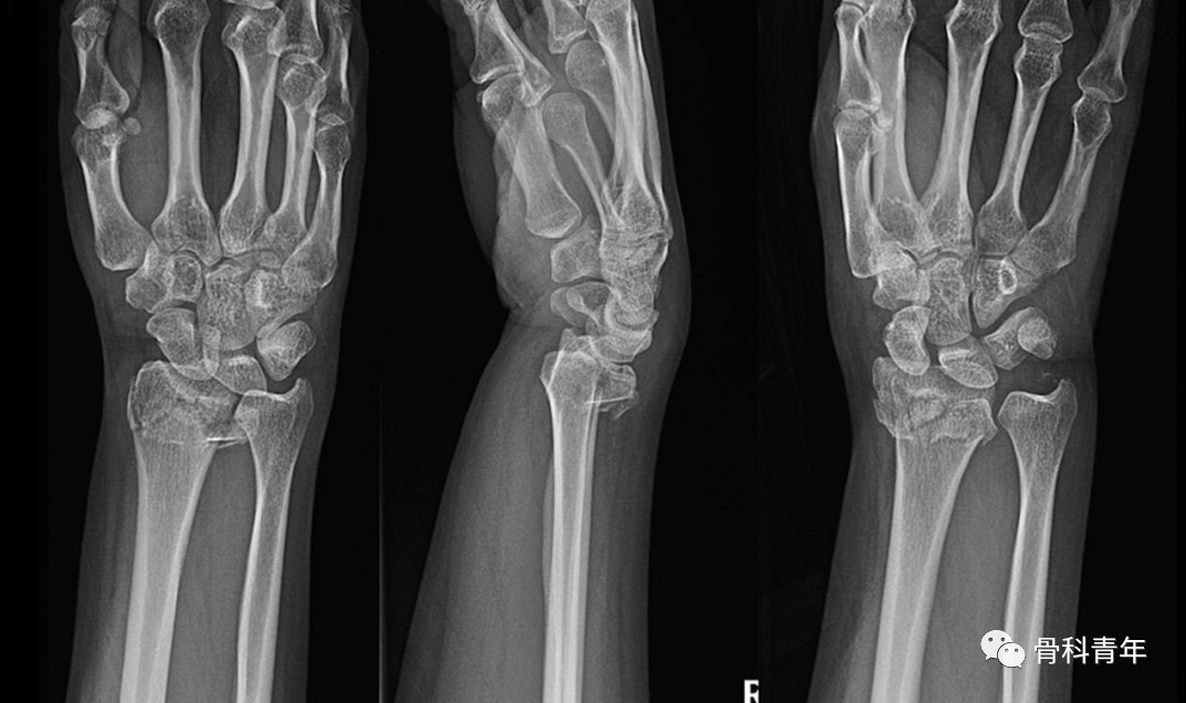 介绍4种桡骨远端骨折的新型内固定技术