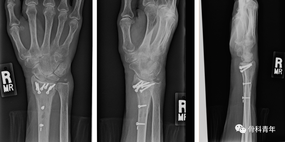 介绍4种桡骨远端骨折的新型内固定技术