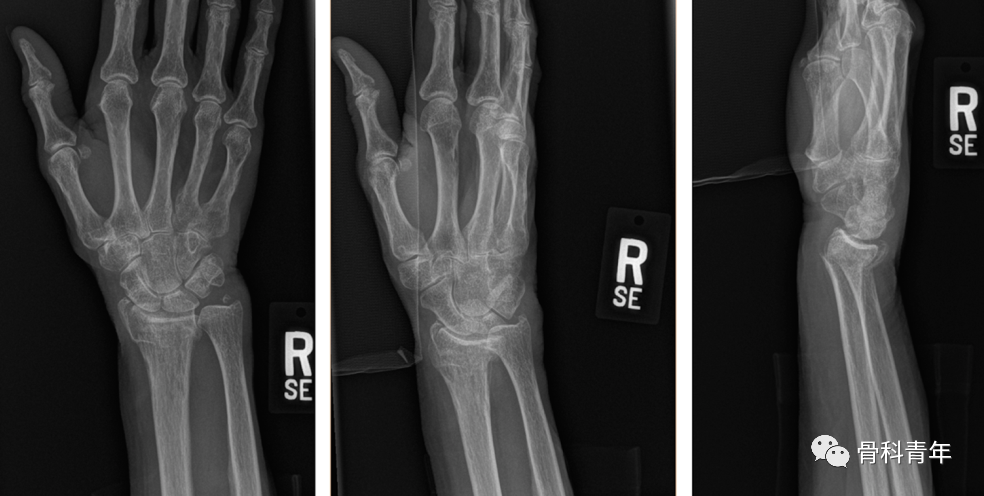 介绍4种桡骨远端骨折的新型内固定技术