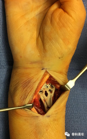 介绍4种桡骨远端骨折的新型内固定技术