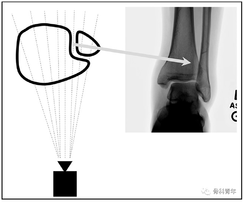 如何安全、有效地经皮置入后踝螺钉？
