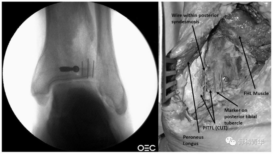 如何安全、有效地经皮置入后踝螺钉？