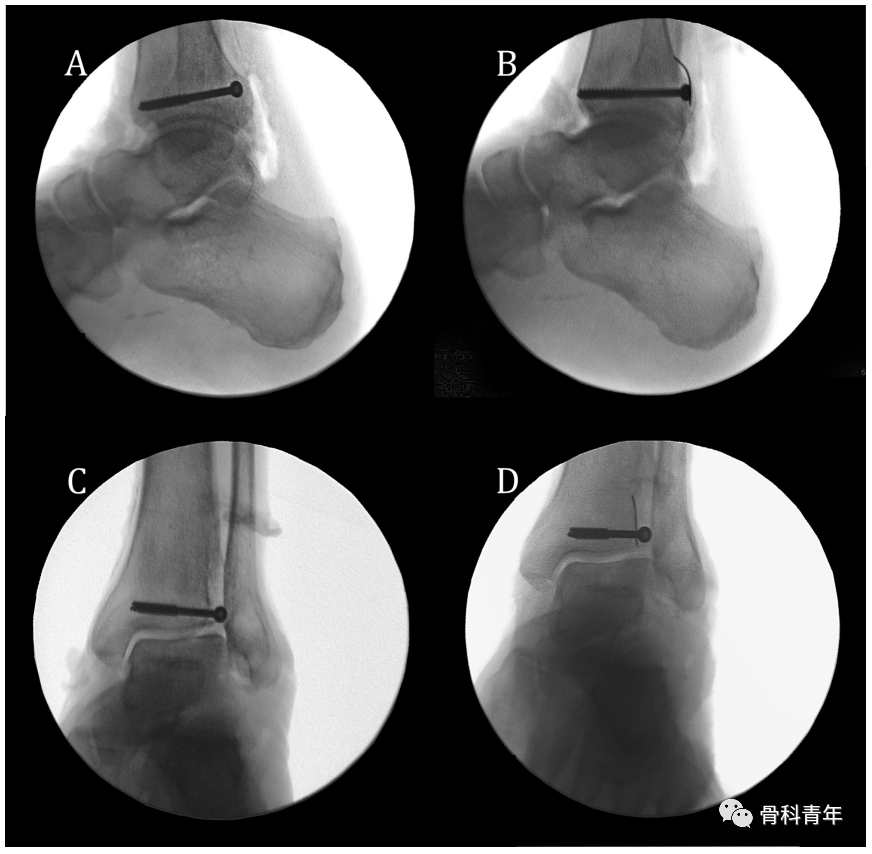 如何安全、有效地经皮置入后踝螺钉？