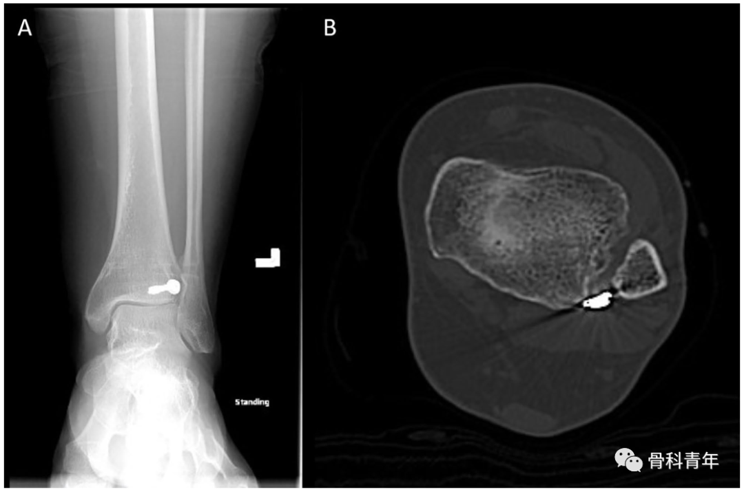如何安全、有效地经皮置入后踝螺钉？