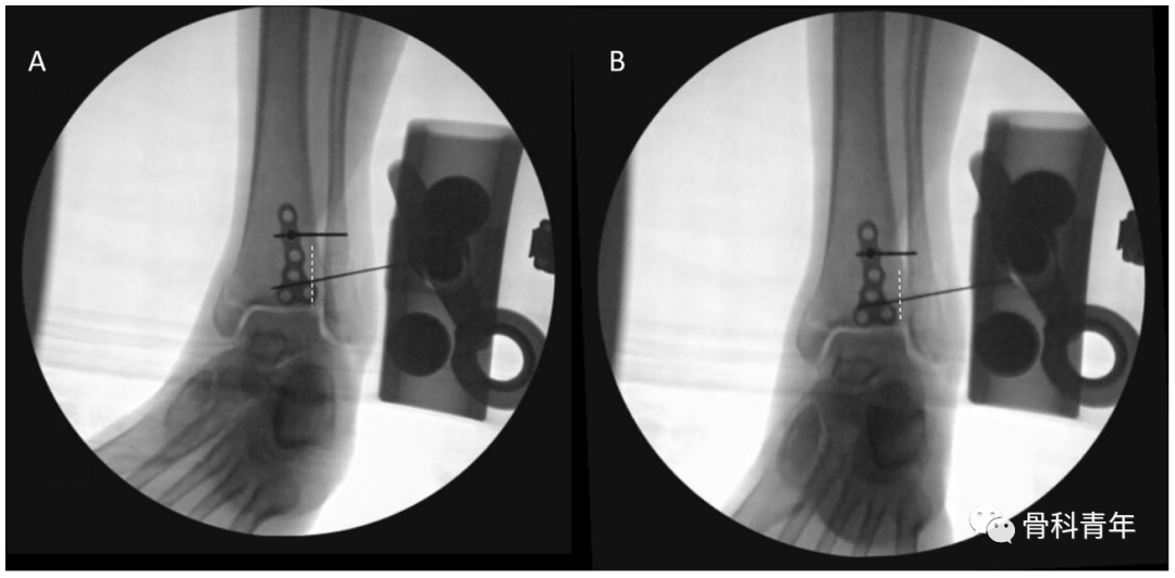 如何安全、有效地经皮置入后踝螺钉？
