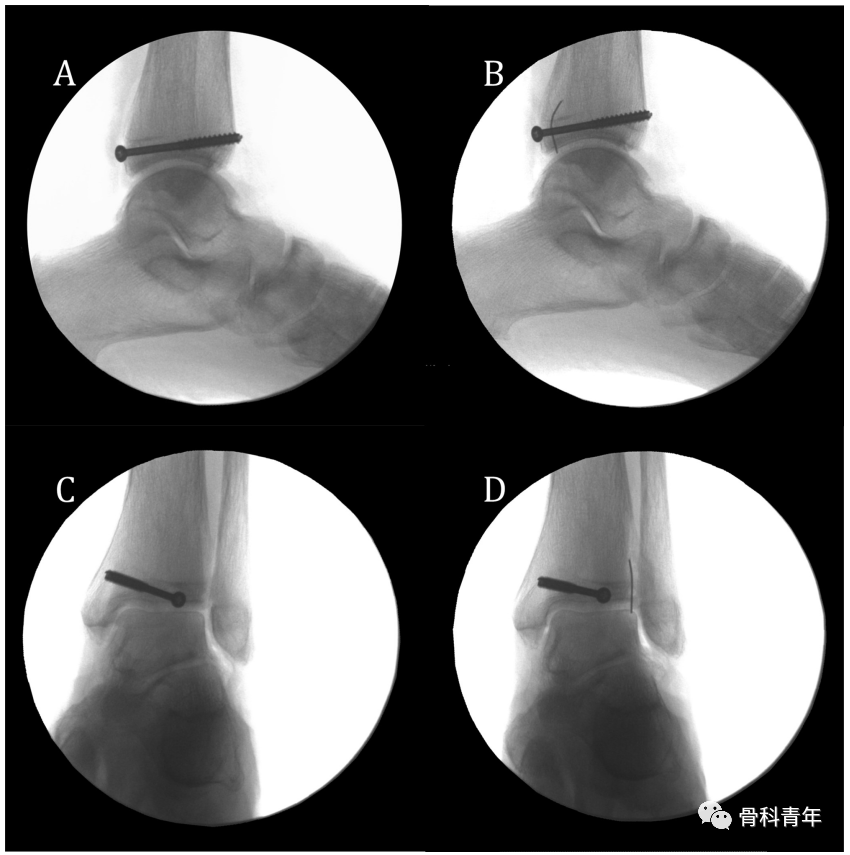 如何安全、有效地经皮置入后踝螺钉？