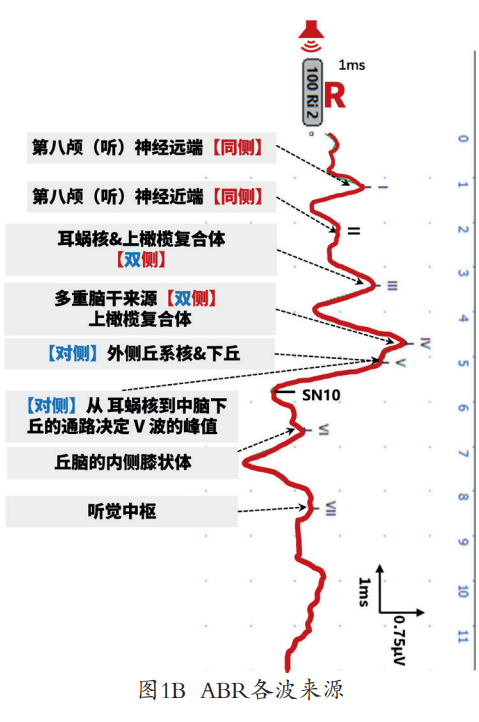 听性脑干反应检查是什么聚焦专题｜2022年第3期临床听力检测技术专题：听性脑干反应临床实践——技术应用到疾病诊断_https://www.jmylbn.com_新闻资讯_第7张