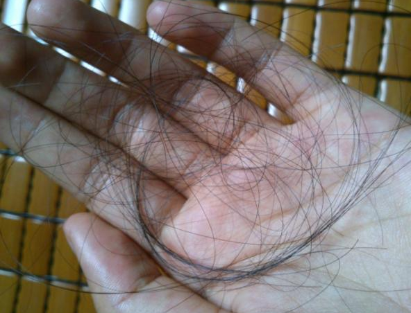 每天掉一两百根头发是脱发吗？掉多少头发算脱发？