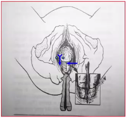 kielland产钳怎么翻译每周一课 ｜ 你所需要的阴道助产技术点，都在这里_https://www.jmylbn.com_新闻资讯_第21张