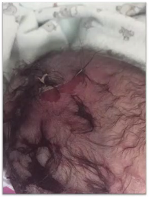 kielland产钳怎么翻译每周一课 ｜ 你所需要的阴道助产技术点，都在这里_https://www.jmylbn.com_新闻资讯_第12张