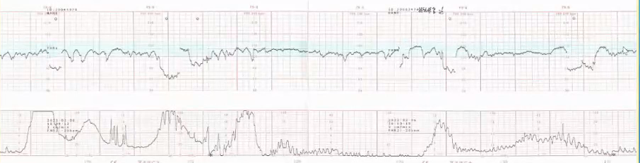 胎监cst是什么【温故知新】熟悉电子胎心监护判读要点，正确掌握胎监图纸解读六步法_https://www.jmylbn.com_新闻资讯_第41张