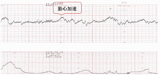 胎监cst是什么【温故知新】熟悉电子胎心监护判读要点，正确掌握胎监图纸解读六步法_https://www.jmylbn.com_新闻资讯_第24张