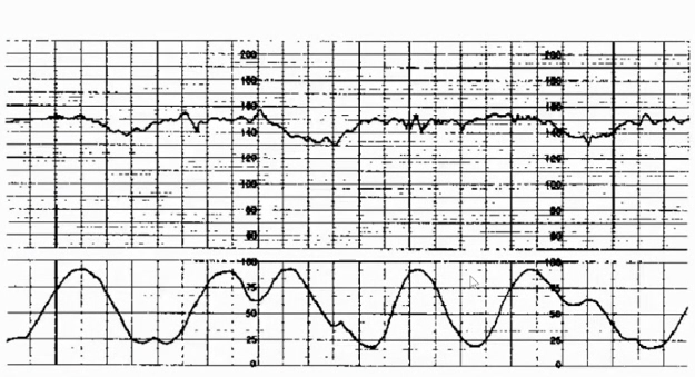 胎监cst是什么【温故知新】熟悉电子胎心监护判读要点，正确掌握胎监图纸解读六步法_https://www.jmylbn.com_新闻资讯_第43张