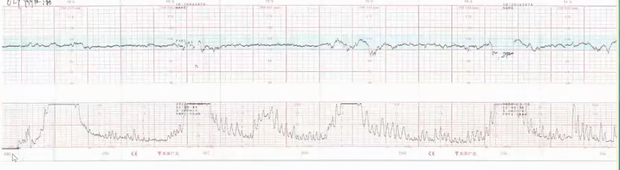 胎监cst是什么【温故知新】熟悉电子胎心监护判读要点，正确掌握胎监图纸解读六步法_https://www.jmylbn.com_新闻资讯_第38张