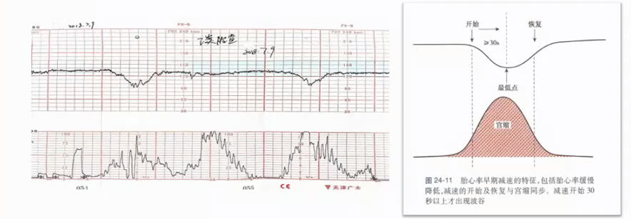 胎监cst是什么【温故知新】熟悉电子胎心监护判读要点，正确掌握胎监图纸解读六步法_https://www.jmylbn.com_新闻资讯_第26张