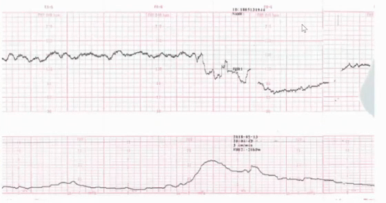 胎监cst是什么【温故知新】熟悉电子胎心监护判读要点，正确掌握胎监图纸解读六步法_https://www.jmylbn.com_新闻资讯_第32张