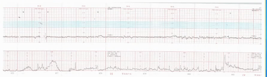 胎监cst是什么【温故知新】熟悉电子胎心监护判读要点，正确掌握胎监图纸解读六步法_https://www.jmylbn.com_新闻资讯_第13张