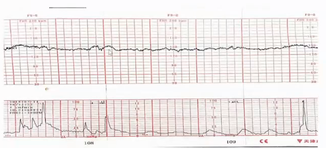 胎监cst是什么【温故知新】熟悉电子胎心监护判读要点，正确掌握胎监图纸解读六步法_https://www.jmylbn.com_新闻资讯_第20张