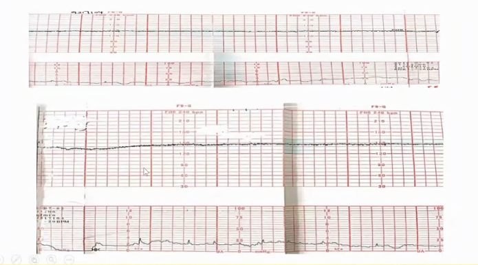 胎监cst是什么【温故知新】熟悉电子胎心监护判读要点，正确掌握胎监图纸解读六步法_https://www.jmylbn.com_新闻资讯_第16张