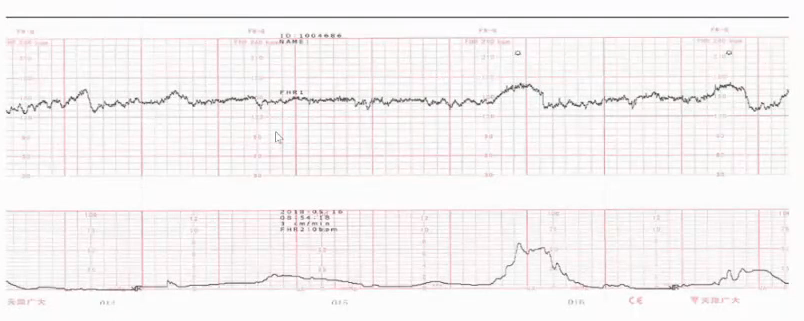 胎监cst是什么【温故知新】熟悉电子胎心监护判读要点，正确掌握胎监图纸解读六步法_https://www.jmylbn.com_新闻资讯_第10张