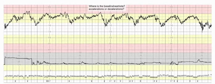 胎监cst是什么【温故知新】熟悉电子胎心监护判读要点，正确掌握胎监图纸解读六步法_https://www.jmylbn.com_新闻资讯_第22张
