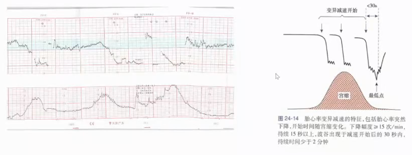 胎监cst是什么【温故知新】熟悉电子胎心监护判读要点，正确掌握胎监图纸解读六步法_https://www.jmylbn.com_新闻资讯_第29张