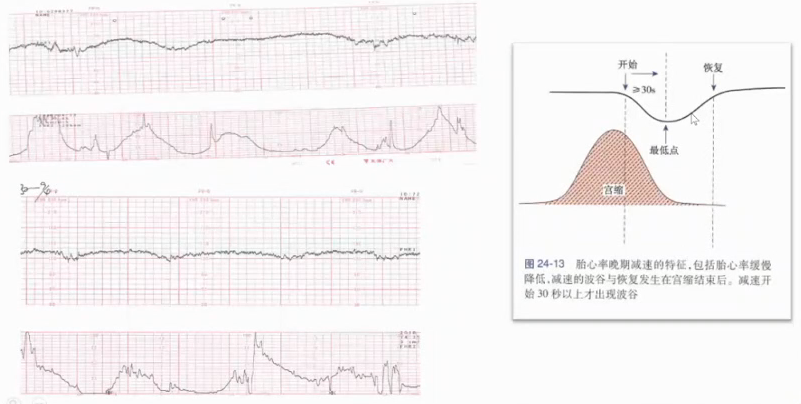 胎监cst是什么【温故知新】熟悉电子胎心监护判读要点，正确掌握胎监图纸解读六步法_https://www.jmylbn.com_新闻资讯_第28张