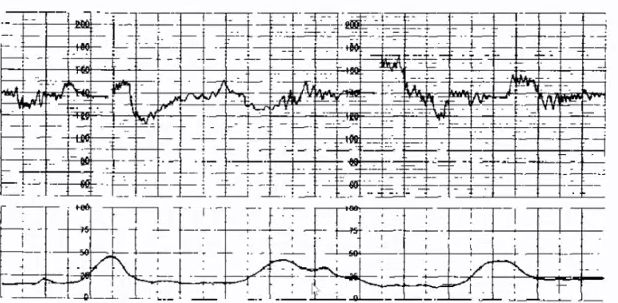 胎监cst是什么【温故知新】熟悉电子胎心监护判读要点，正确掌握胎监图纸解读六步法_https://www.jmylbn.com_新闻资讯_第45张