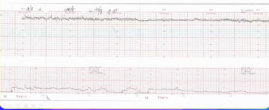 胎监cst是什么【温故知新】熟悉电子胎心监护判读要点，正确掌握胎监图纸解读六步法_https://www.jmylbn.com_新闻资讯_第12张