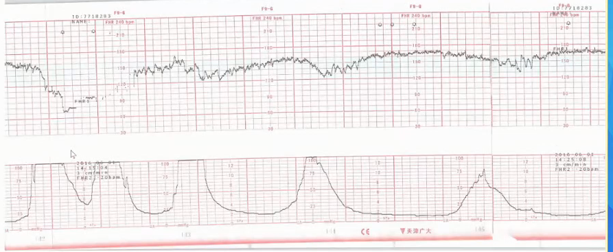 胎监cst是什么【温故知新】熟悉电子胎心监护判读要点，正确掌握胎监图纸解读六步法_https://www.jmylbn.com_新闻资讯_第39张