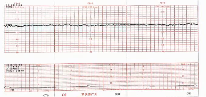 胎监cst是什么【温故知新】熟悉电子胎心监护判读要点，正确掌握胎监图纸解读六步法_https://www.jmylbn.com_新闻资讯_第18张