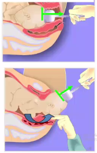 kielland产钳怎么翻译每周一课 ｜ 你所需要的阴道助产技术点，都在这里_https://www.jmylbn.com_新闻资讯_第15张