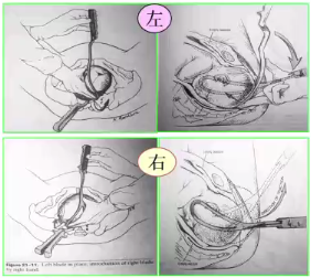 kielland产钳怎么翻译每周一课 ｜ 你所需要的阴道助产技术点，都在这里_https://www.jmylbn.com_新闻资讯_第19张
