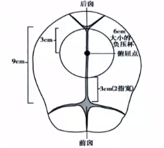 kielland产钳怎么翻译每周一课 ｜ 你所需要的阴道助产技术点，都在这里_https://www.jmylbn.com_新闻资讯_第17张