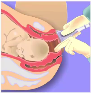 kielland产钳怎么翻译每周一课 ｜ 你所需要的阴道助产技术点，都在这里_https://www.jmylbn.com_新闻资讯_第14张