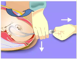 kielland产钳怎么翻译每周一课 ｜ 你所需要的阴道助产技术点，都在这里_https://www.jmylbn.com_新闻资讯_第20张