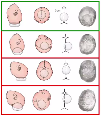 kielland产钳怎么翻译每周一课 ｜ 你所需要的阴道助产技术点，都在这里_https://www.jmylbn.com_新闻资讯_第18张