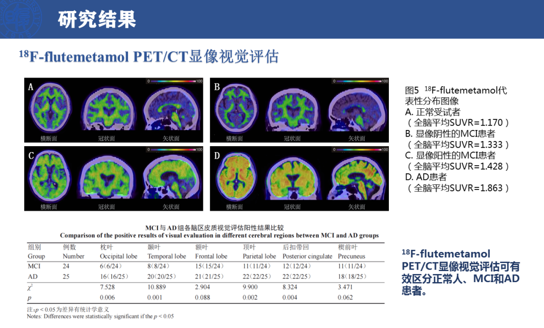 科学网—轻度认知功能障碍与阿尔茨海默病18F-flutemetamol PET/CT脑显像初步研究 - 霍宏的博文