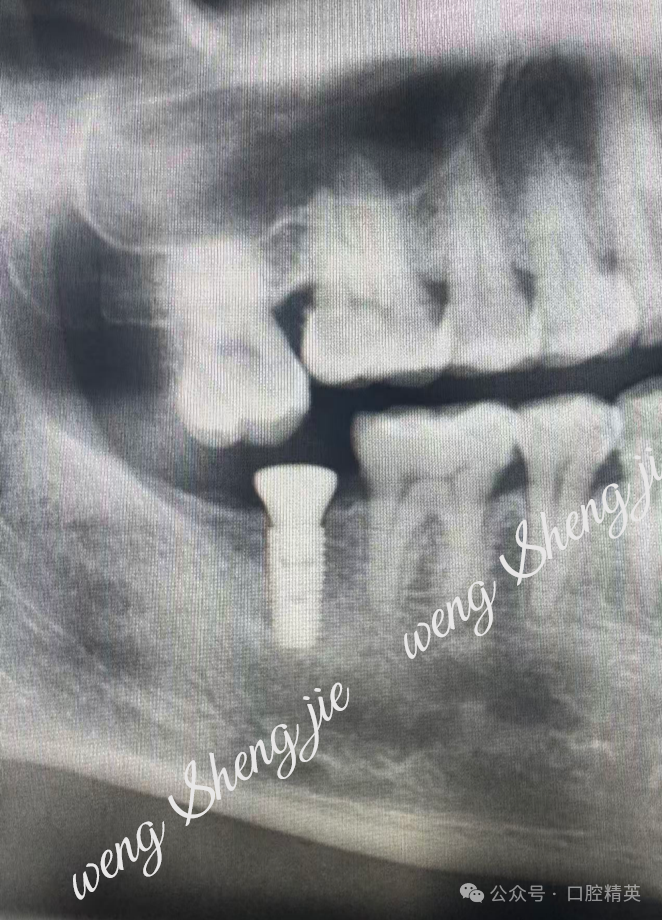 愈合基台压低对颌牙（1年随访复诊）