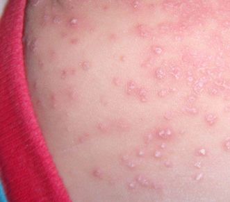 小兒濕疹（atopic dermatitis，AD） 健康 第3張