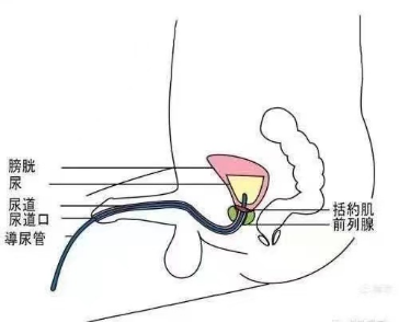 为什么要引流尿袋尿管居家护理科普_https://www.jmylbn.com_新闻资讯_第38张