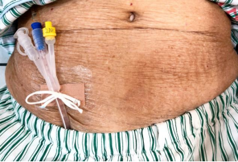 为什么要引流尿袋尿管居家护理科普_https://www.jmylbn.com_新闻资讯_第35张