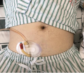 为什么要引流尿袋尿管居家护理科普_https://www.jmylbn.com_新闻资讯_第33张