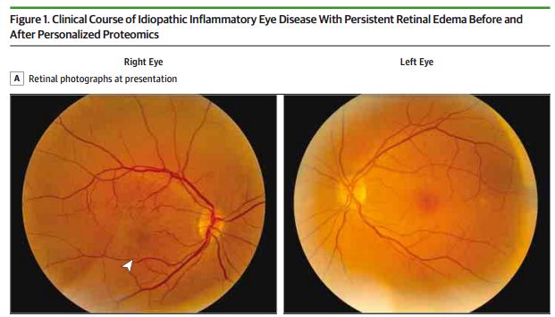 RayBiotech抗体芯片在葡萄膜炎精准医疗中的应用(图2)
