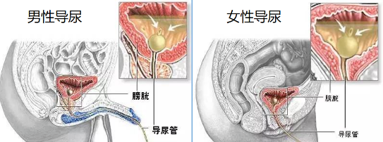 导尿袋有哪些型号护士请收藏！关于导尿，这些问题你都掌握了吗？_https://www.jmylbn.com_新闻资讯_第2张