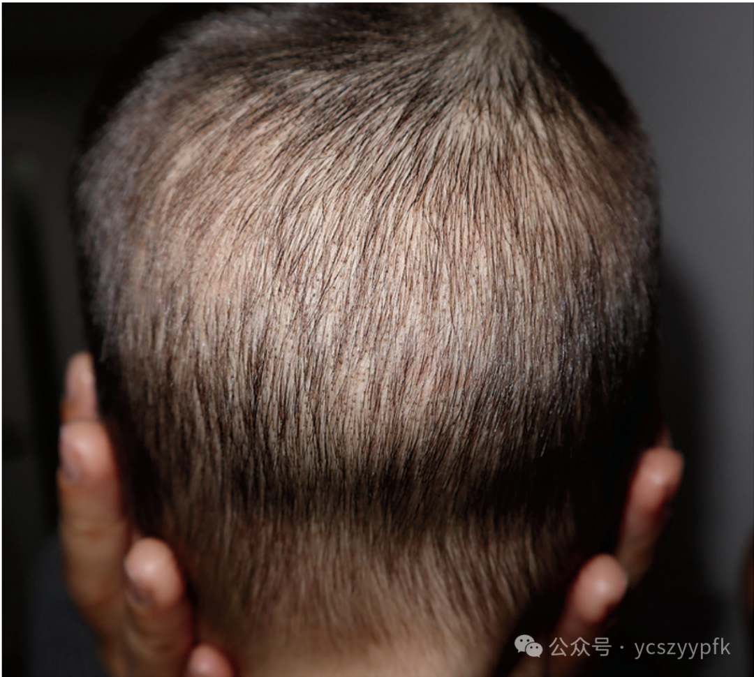 【健康宣教】童年小敌——了解与防治头癣