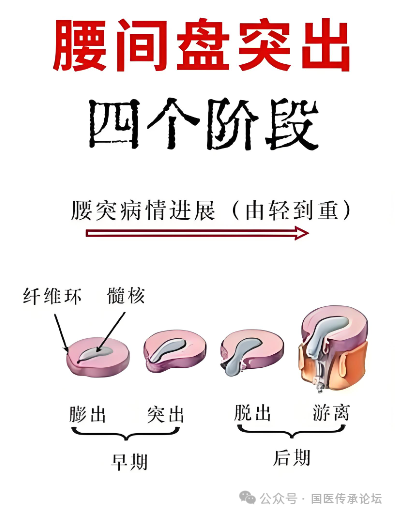 腰间盘突出丨七大经典名方