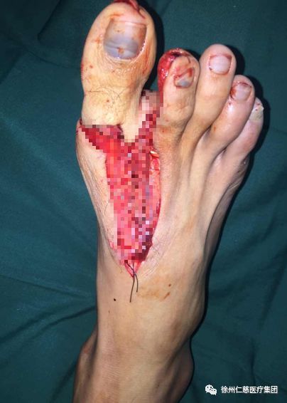 脚趾"变"拇指,医生巧妙再造,小伙玩游戏"11杀吃鸡"